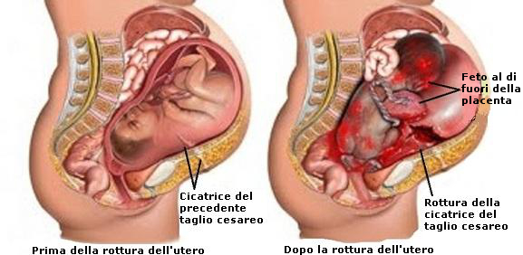 rottura-dell-utero