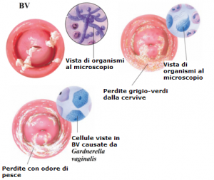 tipo-infezioni-vie-urinarie