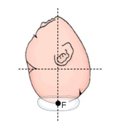 posizionamento-ventosa-ostetrica