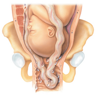 prolasso-cordone-ombellicale