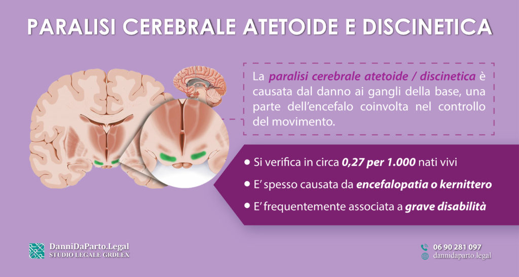 Paralisi-cerebrale-atetoide-discinetica