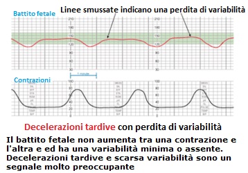 Decelerazione normale