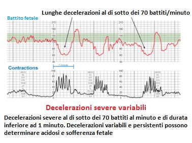 Decelerazioni severe variabili