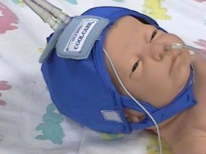 Neonato con caschetto termico per il trattamento dell'encefalopatia ipossico ischemica