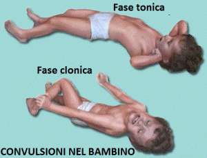 Convulsioni-nel-bambino