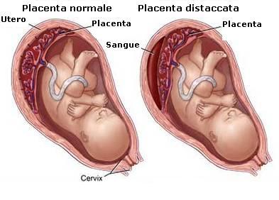 Distacco-della-placenta