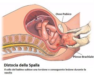 Distocia-della-Spalla