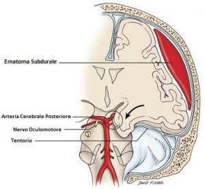 Ematoma-Subdurale