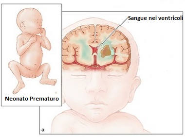 Emorragia-Intraventricolare