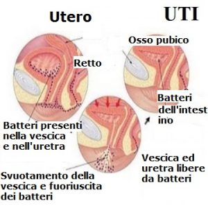 Infezioni-tratto-urinario