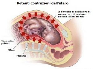 iperstimolazione-utero