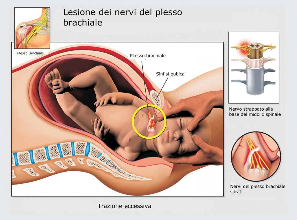 Lesione-nervi-plesso-brachiale