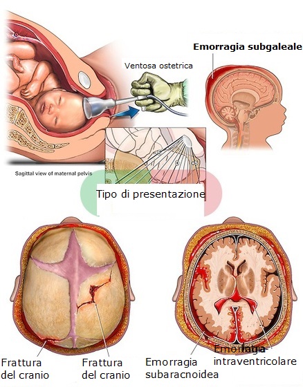 Lesioni-causate-da-ventosa-ostetrica