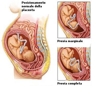 Media-Placenta-Previa