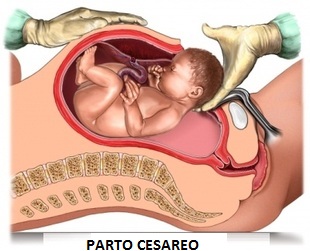 Parto-Cesareo