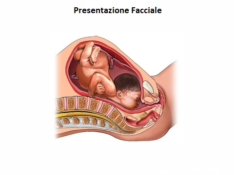 Presentazione-Facciale-parto