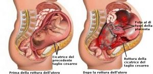 Rottura-dell-utero