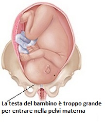 Sproporzione-cefalo-pelvica