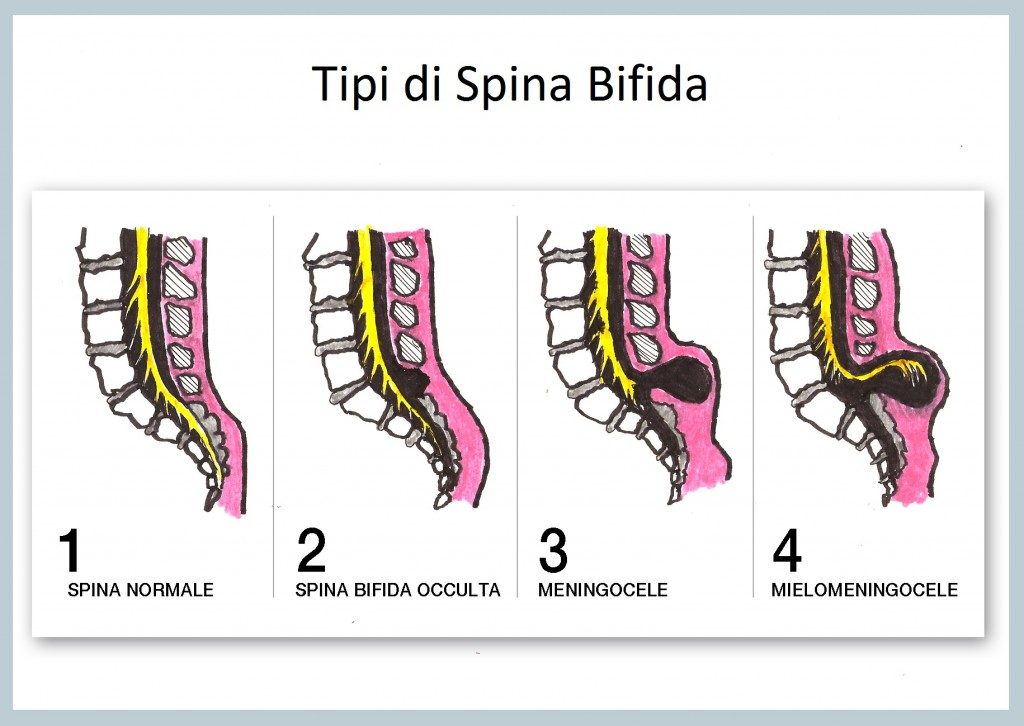 Tipi-spina-bifida
