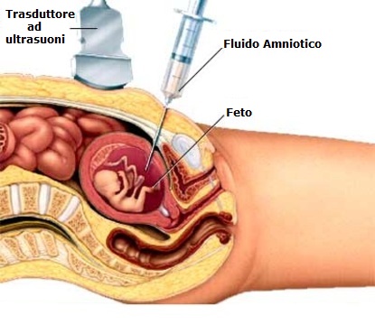 amniocentesi