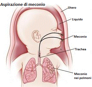 aspirazione-di-meconio