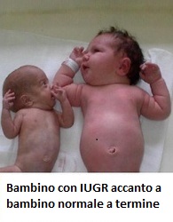 bambino-con-IUGR