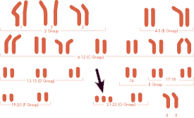 cromosomi-sindrome-di-Down