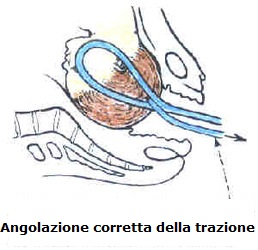 Angolazione-corretta-della-trazione