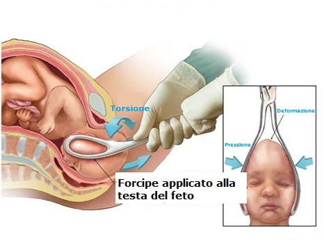 forcipe-applicato-alla-testa-del-feto