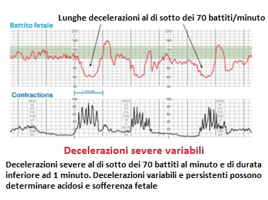 lunghe-decelerazioni-severe-variabili