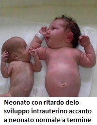 neonato-arresto-sviluppo