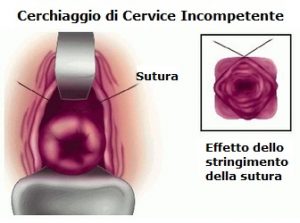 normale-Cerchiaggio