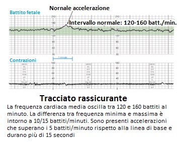 normale-tracciato-rassicurante