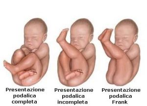 posizione-parto-podalico