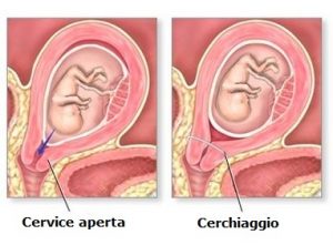 iccola-Cerchiaggio-e-Cervice-aperta