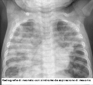radiografia-neonato-con-sindrome-da-aspirazione-meconio