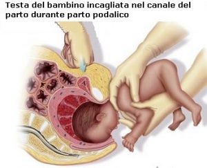 testa-bambino-incagliata-nel-canale-parto