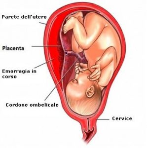 Distacco-della-placenta