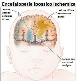 Encefalopatia-Ipossico-Ischemica