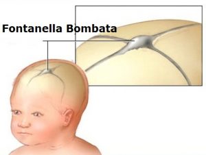 Fontanella-bombata