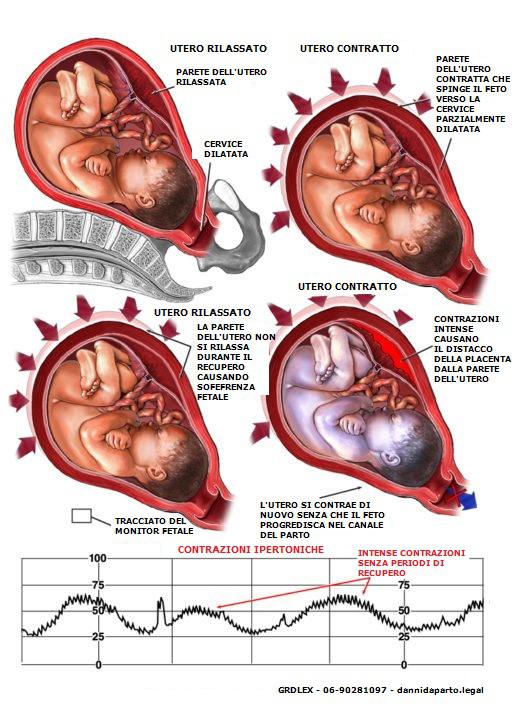 Iperstimolazione-dell-utero-e-contrazioni-ipertoni
