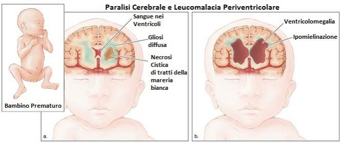 Illustrazione sulle cause e conseguenze della leucomalacia periventricolare e paralisi cerebrale