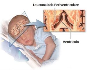 Illustrazione sulla leucomalacia periventricolare con dettaglio