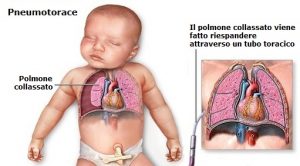 Pneumotorace