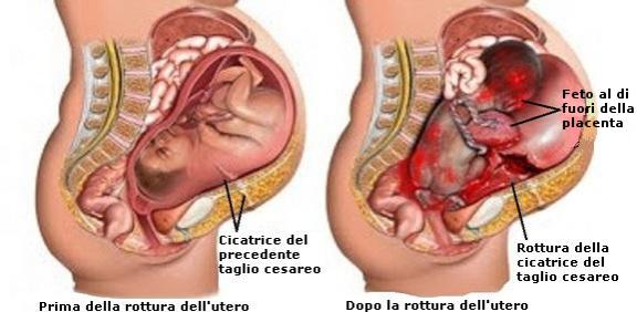 Rottura-dell-utero