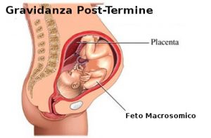 gravidanza-post-termine