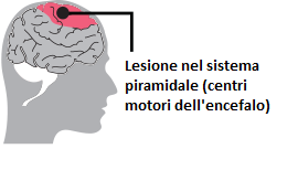 lesione-pci-spastica