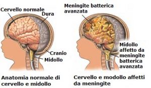 meningite