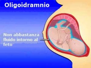 oligoidramnio