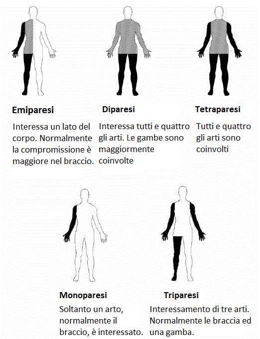 tipi-di-paralisi-spastica